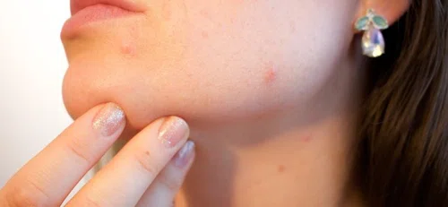 Jakie produkty powodują trądzik?