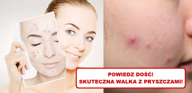 Dokuczają Ci PRYSZCZE? Wypróbuj domowe sposoby!