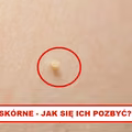 TAGI SKÓRNE – Zobacz jak się ich pozbyć