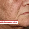 Naturalne sposoby na PRZEBARWIENIA NA SKÓRZE