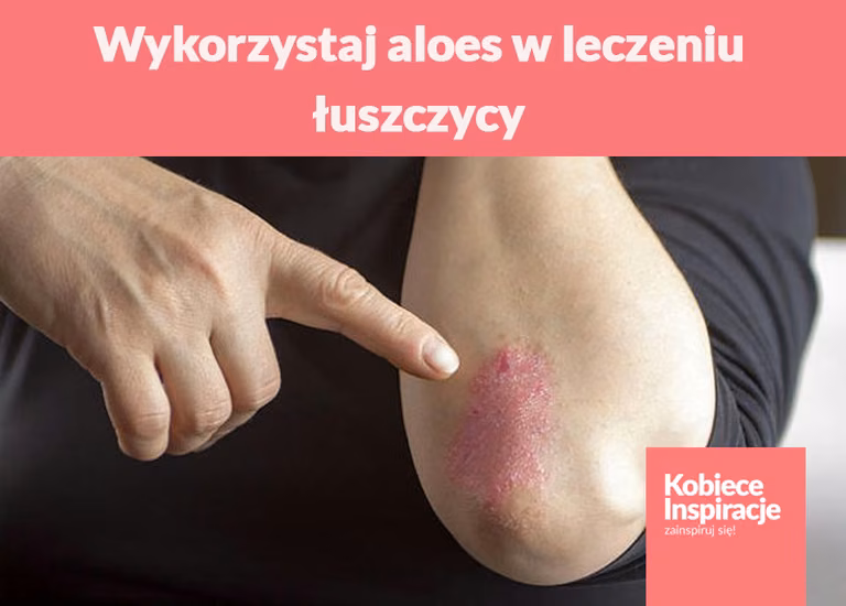 Wykorzystaj aloes w leczeniu łuszczycy