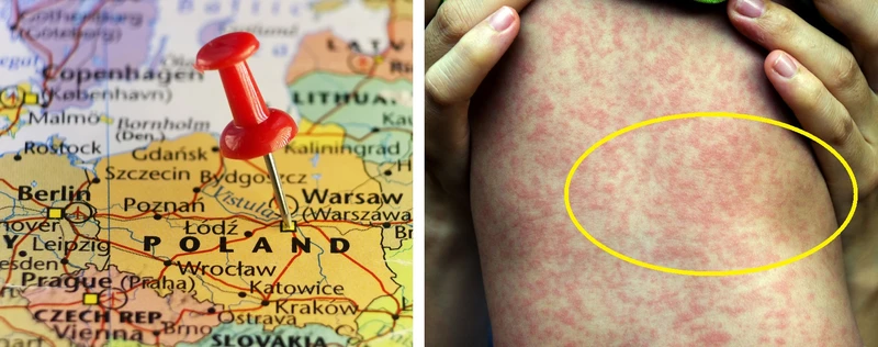 Nowe ognisko odry w Polsce. Jakich objawów nie wolno ignorować?