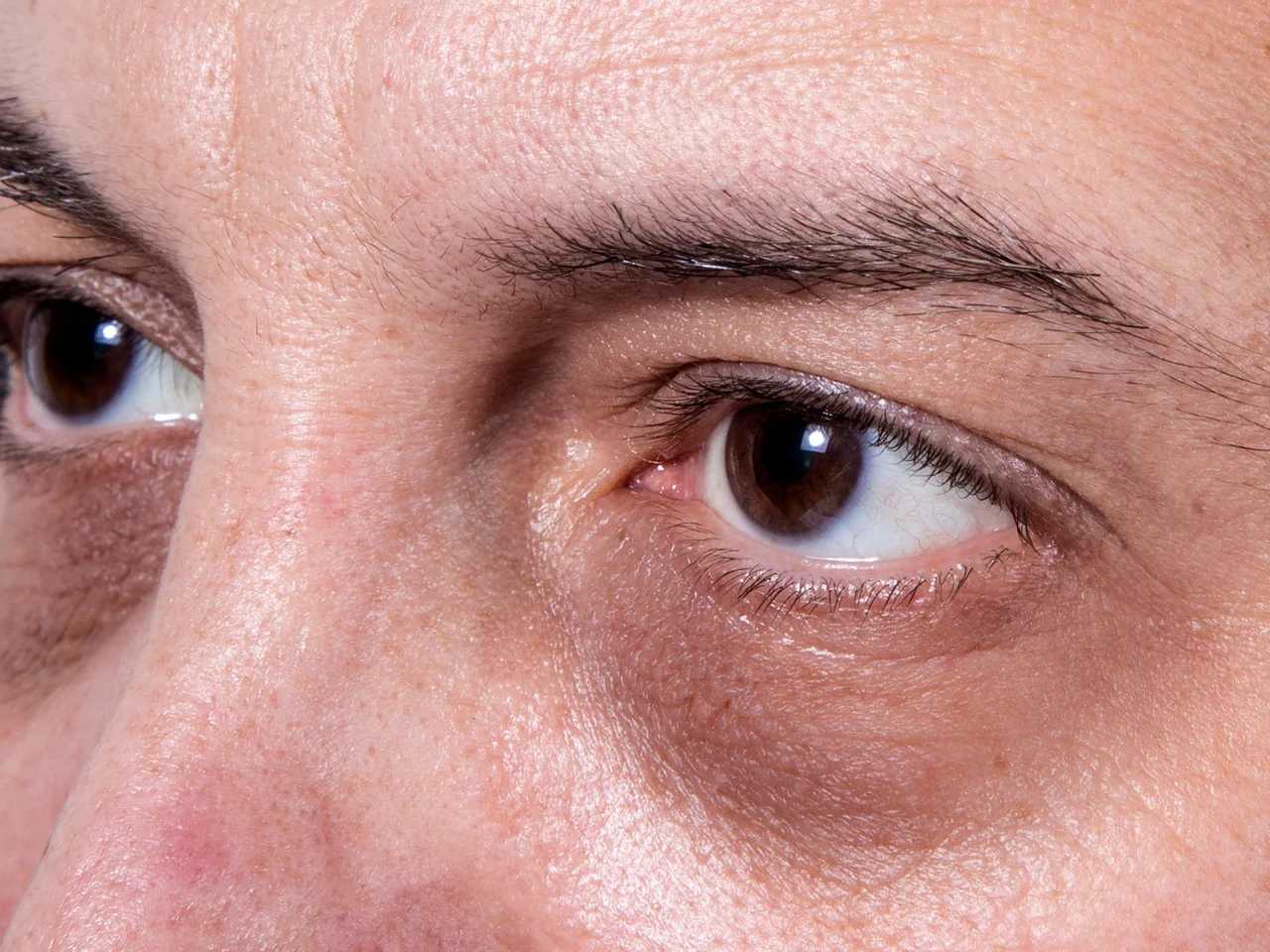 Dlaczego skóra wokół oczu jest podrażniona? Sprawdź możliwe przyczyny!