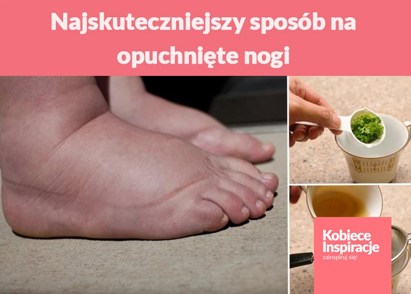 Najskuteczniejszy sposób na opuchnięte nogi