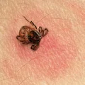 Naturalne sposoby walki z kleszczami