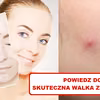 Dokuczają Ci PRYSZCZE? Wypróbuj domowe sposoby!