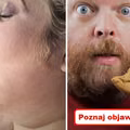 Poznaj objawy zbyt wysokiego poziomu CUKRU!