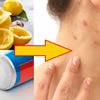 Masz problem z PRYSZCZAMI? Wypróbuj najtańszy sposób!