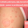 Orzech włoski, pokrzywa, dąb, korzeń wierzby i nagietek - Twoja pomoc w problemach skórnych
