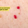 Takie czerwone kropki na ciele mogą pojawić się u Ciebie po 30, roku życia!