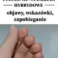 UCZULENIE NA HYBRYDĘ – objawy, wskazówki, zapobieganie