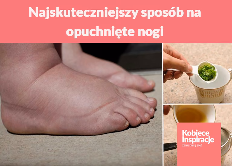 Najskuteczniejszy sposób na opuchnięte nogi