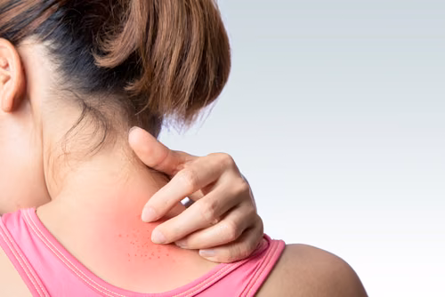 Nowym objawem koronawirusa mogą być zmiany skórne? Francuscy dermatolodzy ostrzegają!