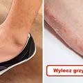 GRZYBICA? Wypróbuj naturalne sposoby!