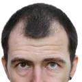 Jak zapobiec łysieniu?