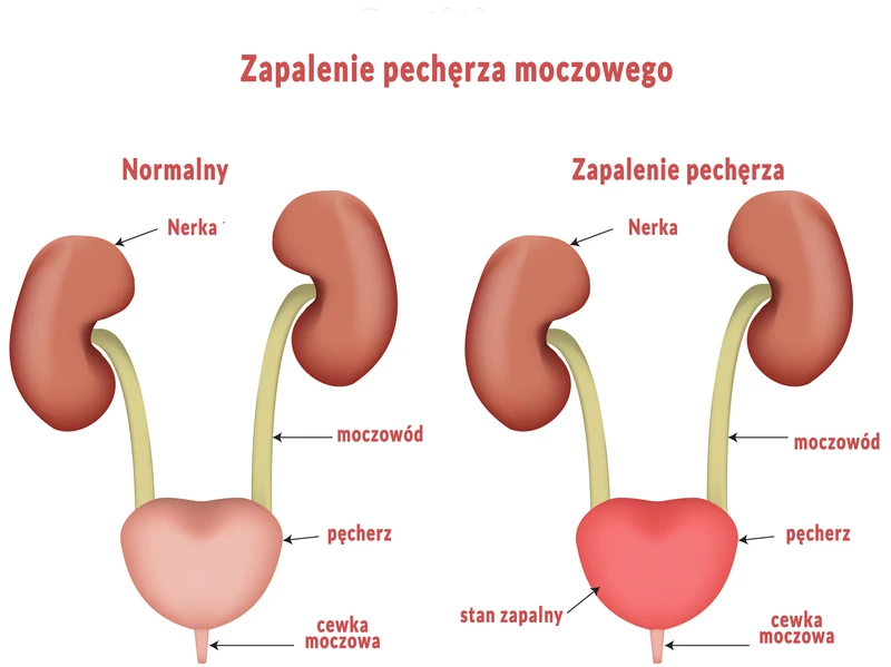 Lista 9 sposobów na wyleczenie zapalenia pęcherza