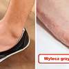 GRZYBICA? Wypróbuj naturalne sposoby!