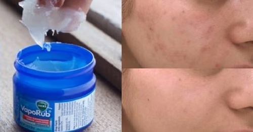 Dlaczego maść VapoRub tak skutecznie zwalcza trądzik?