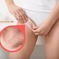 Żegnajcie czerwone kropki po goleniu bikini! Najlepsze preparaty i sposoby, które musisz znać!