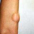 Jak usunąć tłuszczaki domowym sposobem?