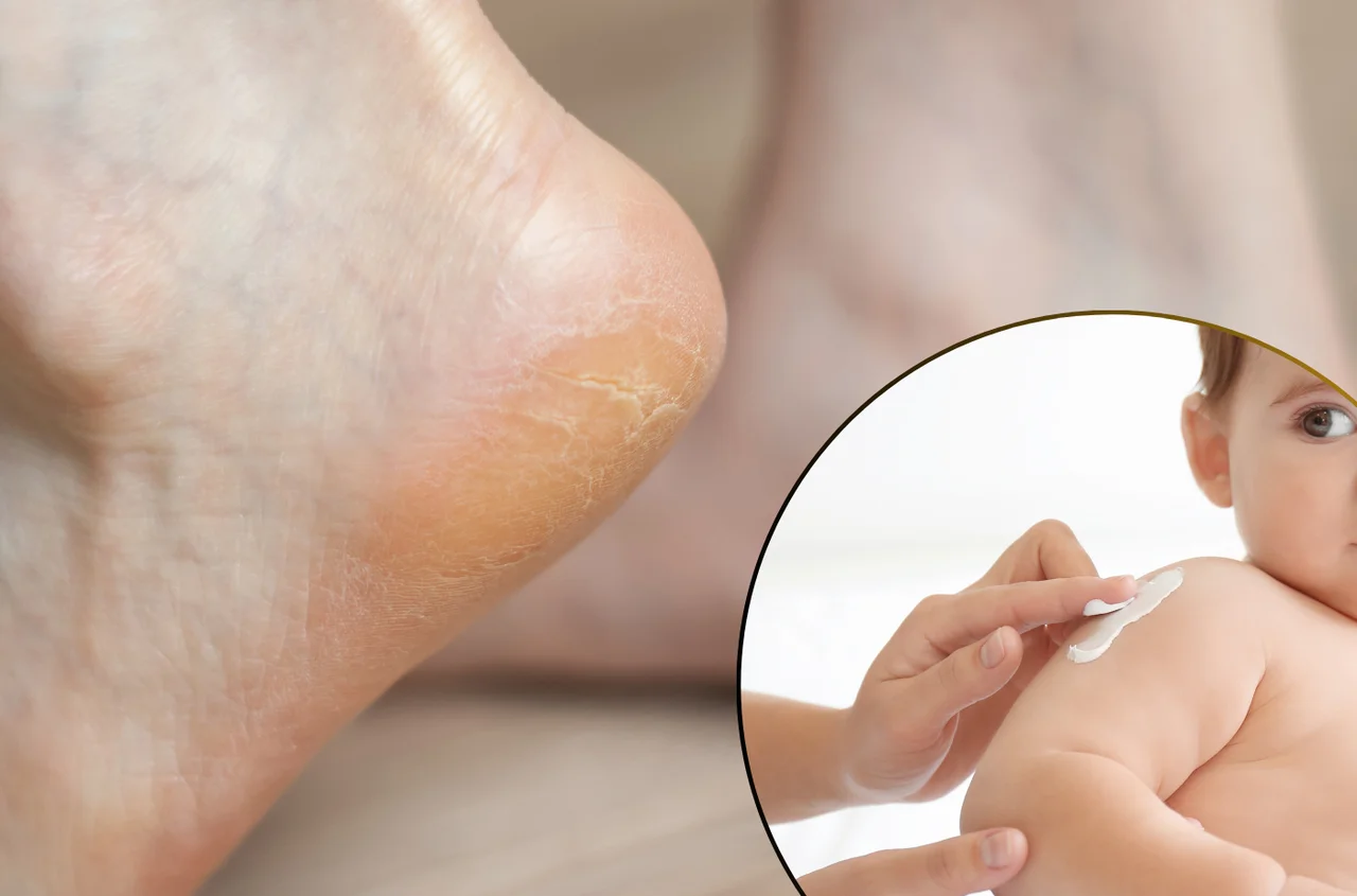 Krem dla niemowląt uratuje twoje suche pięty! Nie uwierzysz, jak działa