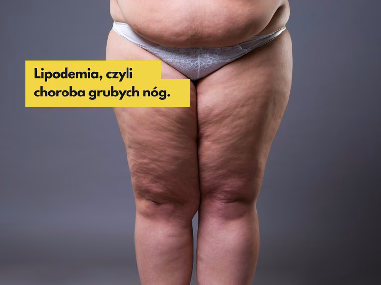 Lipodemia, czyli choroba grubych nóg. Jakie są przyczyny i jak ją leczyć?