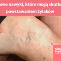 3 główne nawyki, które mogą skutkować powstawaniem żylaków. Większość z nas sama się o nie prosi..