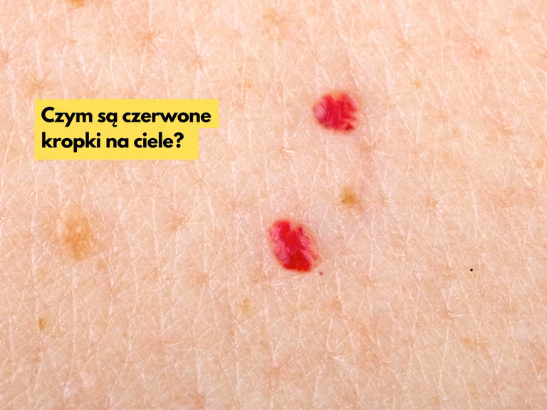 Takie czerwone kropki na ciele mogą pojawić się u Ciebie po 30, roku życia!