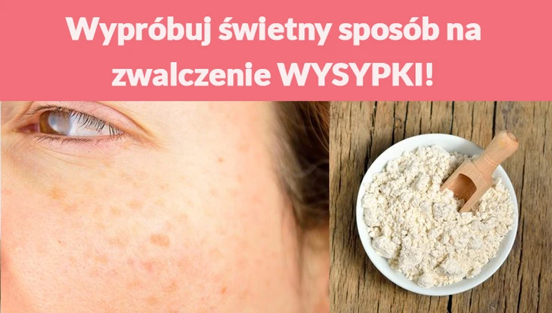 Wypróbuj świetny sposób na zwalczenie WYSYPKI!