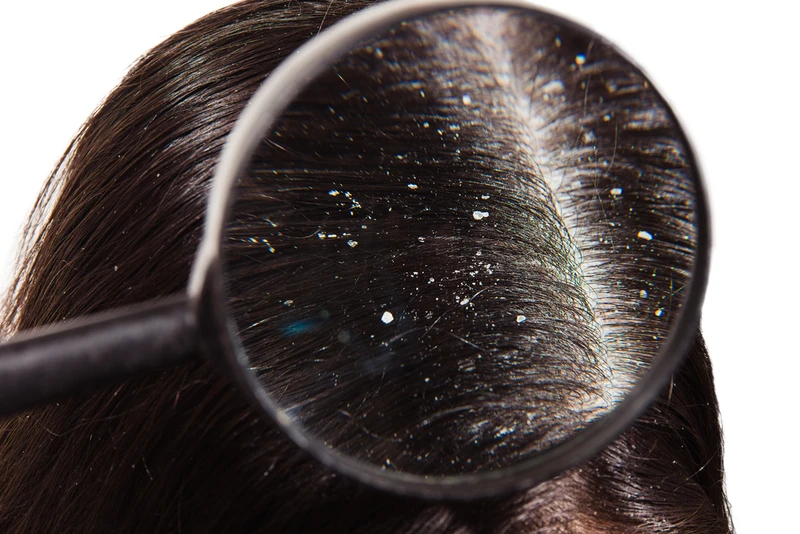 ŚWIETNY SPOSÓB NA ZADBANIE O SKÓRĘ GŁOWY!