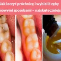 Jak leczyć próchnicę i wybielić zęby domowymi sposobami – najskuteczniejsza metoda