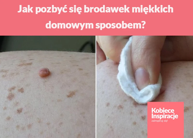 Jak pozbyć się brodawek miękkich domowym sposobem?