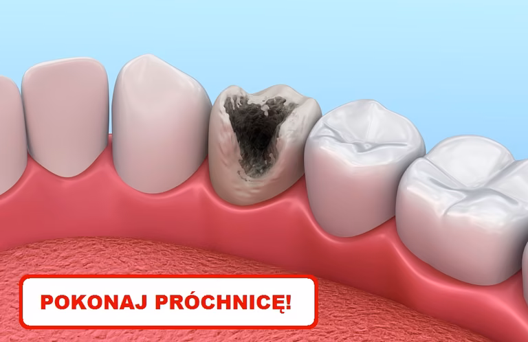 Zobacz jak samemu zwalczyć PRÓCHNICĘ!