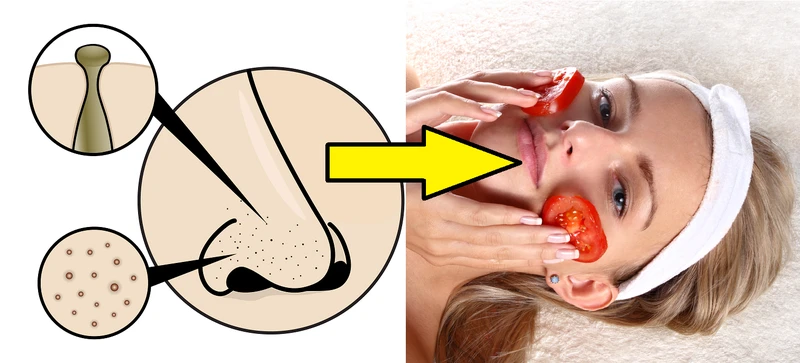 Wągry – pozbądź się ich za pomocą domowych peelingów!