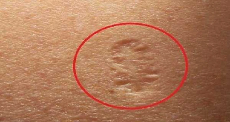 Posiadasz taką bliznę po szczepieniu na ramieniu? Dowiedz się, jaka jest jej przyczyna