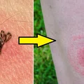 Masz te objawy? To może być BORELIOZA! Nie bagatelizuj tego!