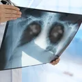 Światowy Dzień Zapalenia Płuc: Zwiększanie Świadomości i Walka z Chorobą
