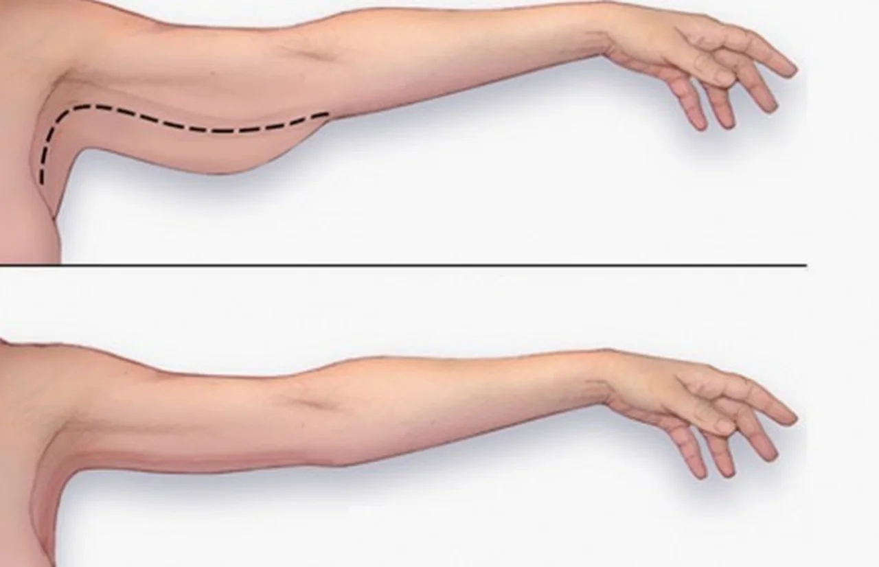 Jak ujędrnić obwisłą skórę ramion?