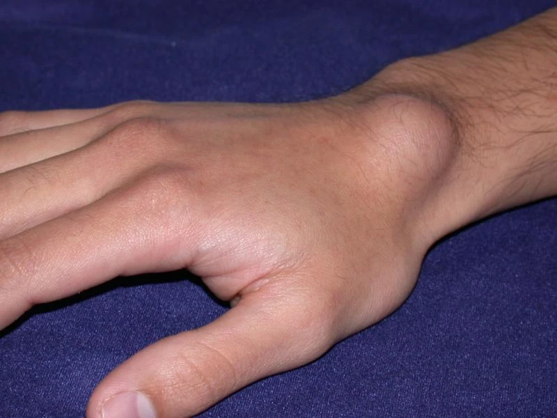 Ganglion – guz na nadgarstku. Jakie mogą być jego skutki?