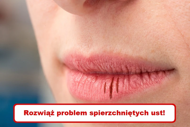 Masz SPIERZCHNIĘTE USTA? Teraz problem rozwiązany!