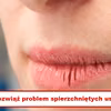 Masz SPIERZCHNIĘTE USTA? Teraz problem rozwiązany!