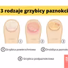Jak rozpoznać rodzaj grzybicy paznokci?