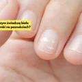 O czym świadczą białe plamki na paznokciach? Sprawdź, czy sama ich nie masz!