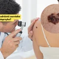Jak odróżnić pieprzyk od czerniaka?