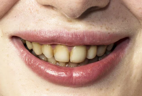 Dlaczego zęby żółkną? 3 główne powody