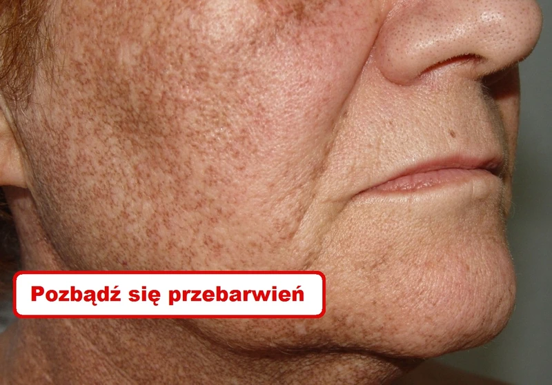 Naturalne sposoby na PRZEBARWIENIA NA SKÓRZE