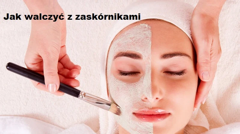Jak walczyć z zaskórnikami