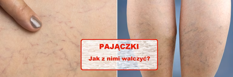 Zauważyłaś na swoim ciele tzw PAJĄCZKI? Pozbądź się ich domowym sposobem