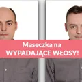 Wypróbuj najbardziej skuteczną maseczkę na WYPADAJĄCE WŁOSY!