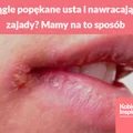 Ciągle popękane usta i nawracające zajady? Mamy na to sposób